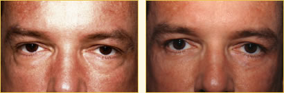 Eyelid Surgery