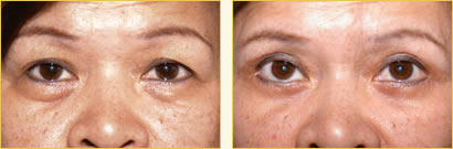 Eyelid Surgery