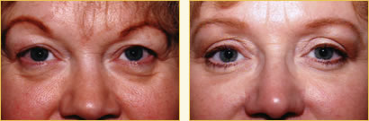 Eyelid Surgery
