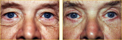 Eyelid Surgery