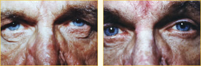 Eyelid Surgery