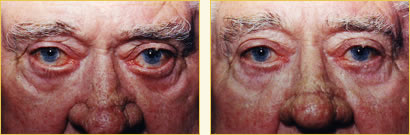 Eyelid Surgery