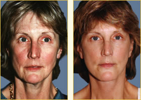Facelift