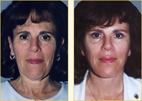 Facelift