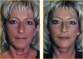 Facelift