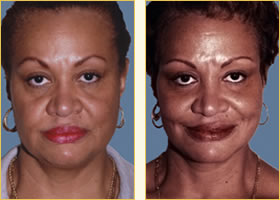 Facelift