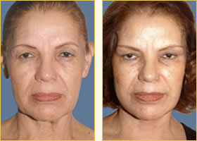 Facelift