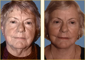 Facelift