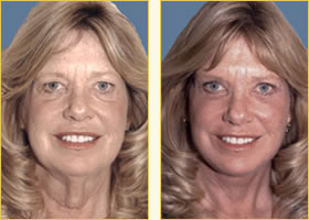 Facelift