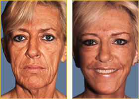 Facelift