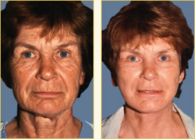 Facelift