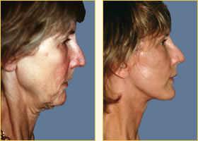 Facelift