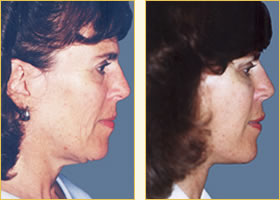 Facelift