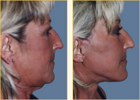 Facelift