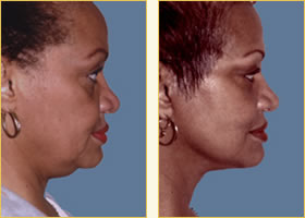 Facelift