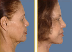 Facelift