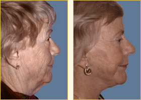Facelift