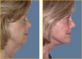 Facelift