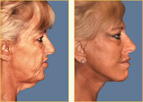 Facelift