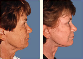 Facelift