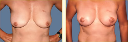 Mastopexy