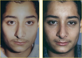 Rhinoplasty - Nose Job