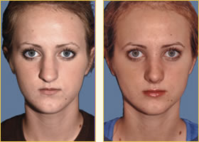 Rhinoplasty