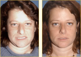 Rhinoplasty - Nose Job