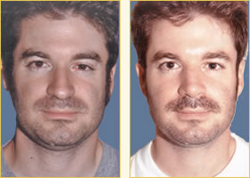 Rhinoplasty - Nose Job