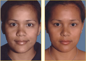 Rhinoplasty - Nose Job