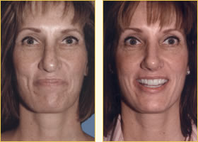 Rhinoplasty