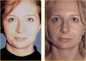 Rhinoplasty