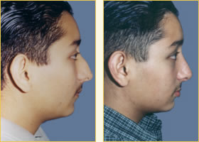 Rhinoplasty - Nose Job
