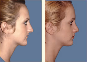 Rhinoplasty