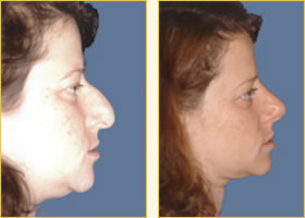 Rhinoplasty - Nose Job