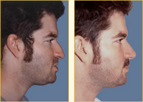 Rhinoplasty - Nose Job