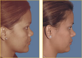 Rhinoplasty - Nose Job