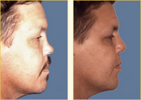 Rhinoplasty - Nose Job