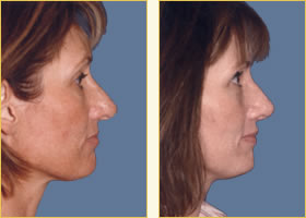 Rhinoplasty - Nose Job