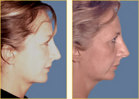 Rhinoplasty