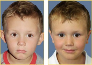 Before and After Otoplasty