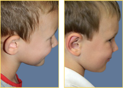 Before and After Otoplasty