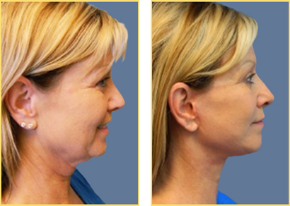 In Office Next Day Facelift