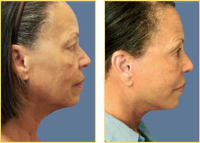 In Office Next Day Facelift