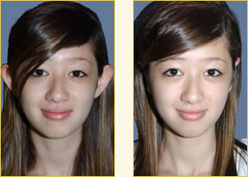 Otoplasty
