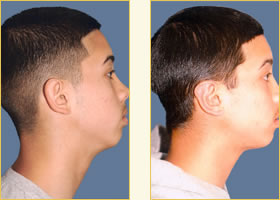 Otoplasty