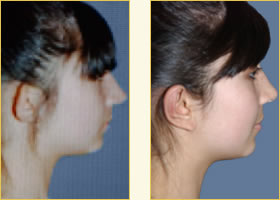 Otoplasty