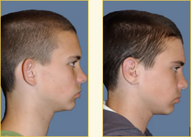 Otoplasty