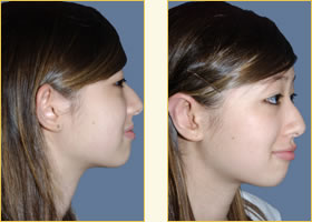 Otoplasty