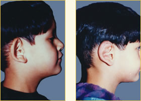 Otoplasty